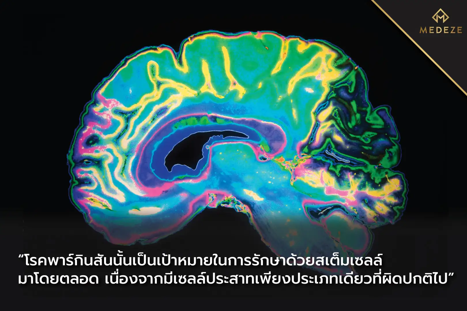 Parkinson’s disease