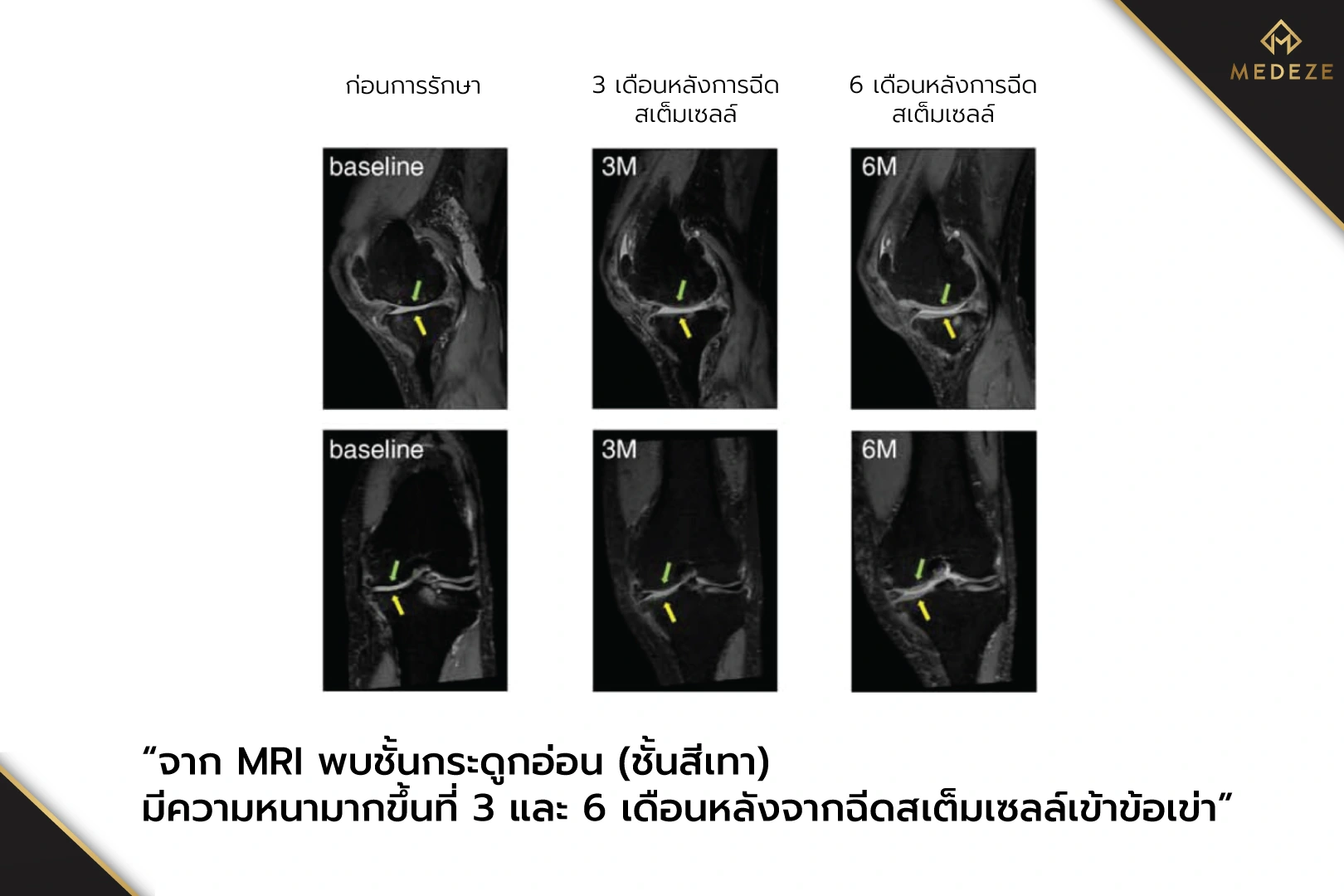 สเต็มเซลล์ข้อเข่า