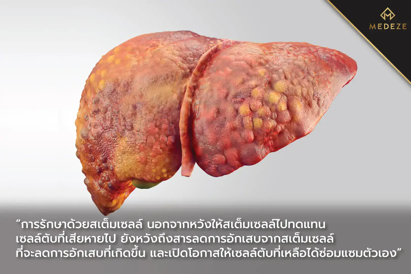 โรคตับเสื่อม