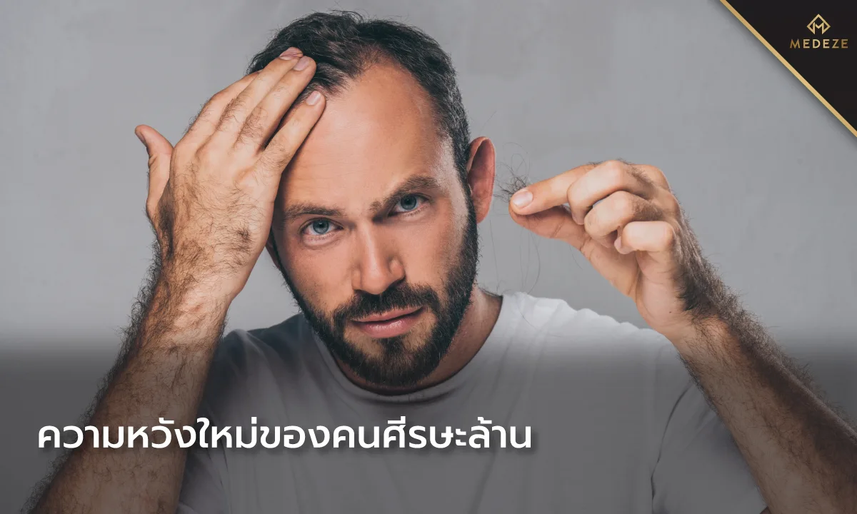 ความหวังใหม่ของคนศีรษะล้าน